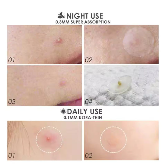 36 Patches Acne Pimple Patch Face Invisible Stickers Quick Effect Treatment Removing Patches Beauty Acne Tools Face Skin Care